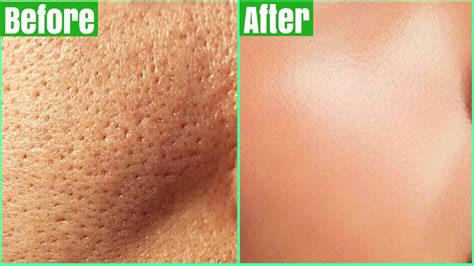 How To Get Rid Of Large Pores Permanently 100 Works Shrink And Get