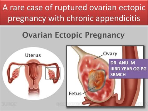 A Rare Case Presentation Of Ovarian Ectopic Pregnancy
