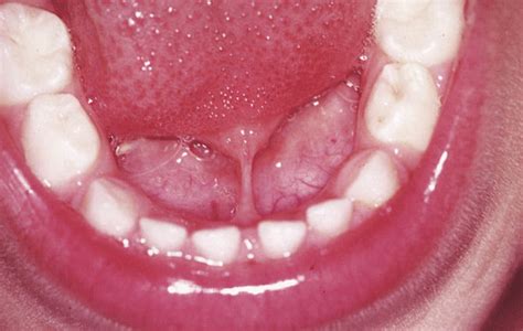 Ankyloglossia Tongue Tie A Short Lingual Frenulum May Interfere With Download Scientific