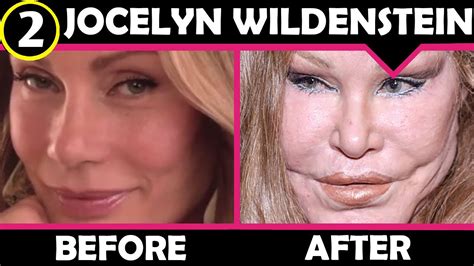 Jocelyn Wildenstein Plastic Surgery Before And After