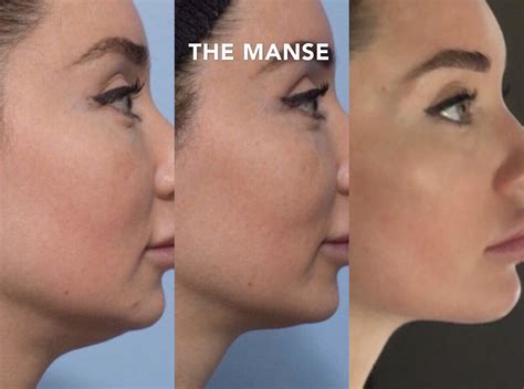 The Benefits Of Jawline Filler For Reducing The Appearance Of A Double