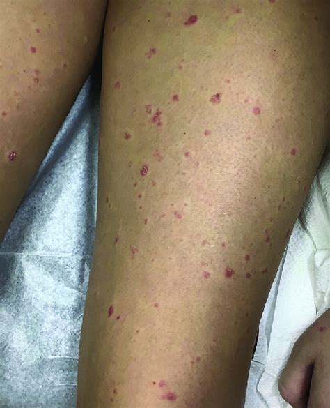 Pityriasis Lichenoides Lesions With Trailing Scale On The Upper Portion