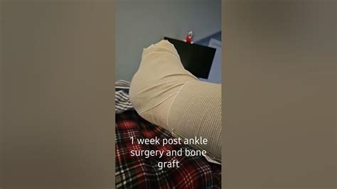 1 Week Post Ankle Surgery Youtube