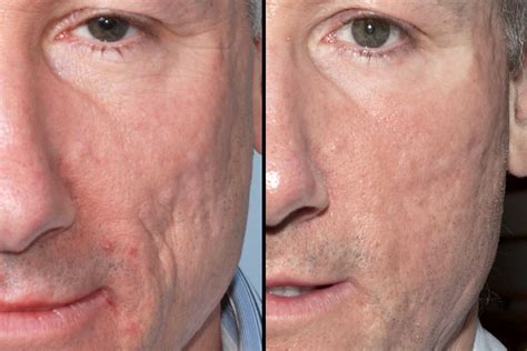 Laser treatment of acne scars. Acne Scar Treatment | Salt Lake City, Utah | Gateway ...