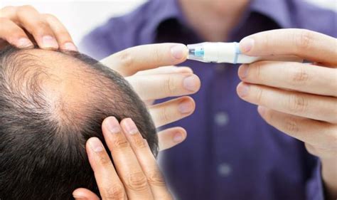 Likewise, if you are having other symptoms such as scalp itching, redness, flaking or unusual distributions of hair loss you may be suffering from seborrheic dermatitis, tinea capitis, psoriasis, or cicatricial (scarring alopecia). Type 2 diabetes: Hair loss could be a warning sign your ...