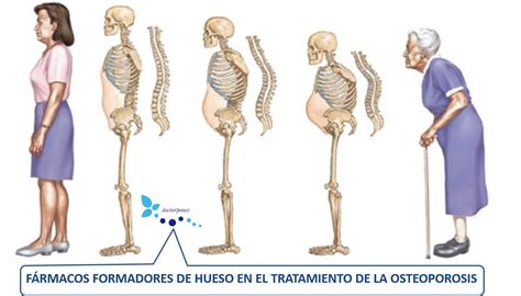 OSTEOFORMADORES EN EL TRATAMIENTO DE LA OSTEOPOROSIS Clínica