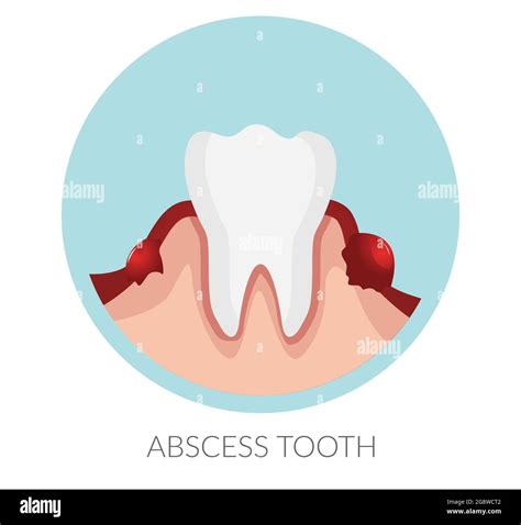 White Teeth Dental Abscess Stock Illustration As Eps 10 File Stock