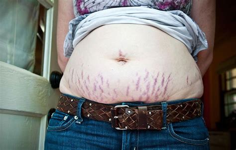 7 Things You Need To Know About Treating Stretch Marks