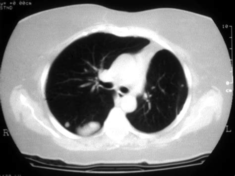Benign Metastasizing Leiomyoma Bml Presenting As Pulmonary Mass