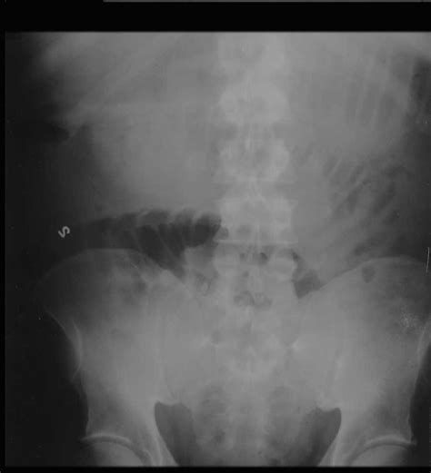 Small Bowel Obstruction On X Ray X Rays Case Studies Ctisus Ct Scanning