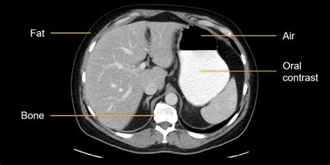 Abdominal Ct Attenuation • Litfl • Radiology Library