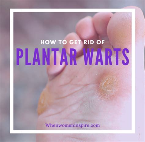 How To Treat And Get Rid Of Plantar Warts When Women Inspire