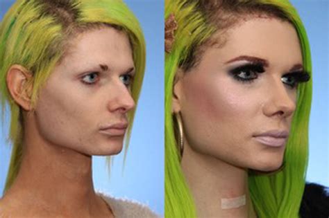 Facial Feminization Surgery Toronto Solomon Facial Plastic