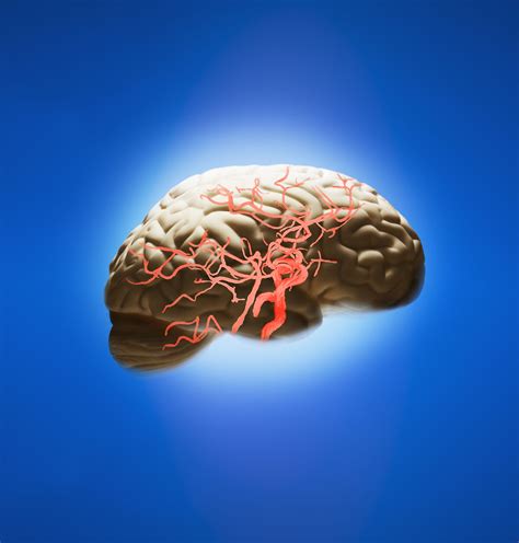 Stroke Caused By Amyloid Angiopathy
