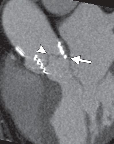 Transcatheter Aortic Valve Replacement Postoperative Ct Findings Of
