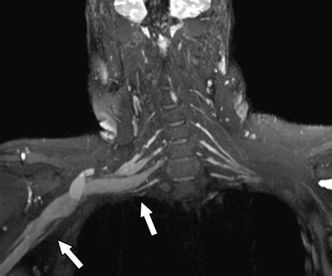 Brachial Plexus Injury Mri