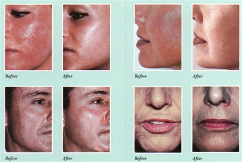 Orange County Ca Chemical Peels Acne Treatment Irvine