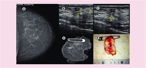 A Nonpalpable Infiltrating Ductal Carcinoma In The Left Breast Marked