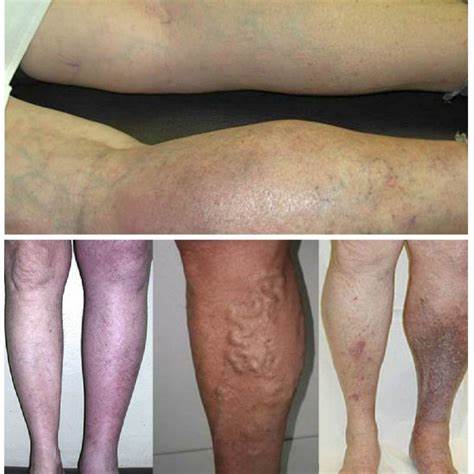 Тромбофлебит нижних конечностей диета Тромбофлебит поверхностных вен нижних конечностей | Trombanet Тромбофлебит поверхностных вен нижних конечностей | Trombanet Тромбофлебит нижних конечностей диета