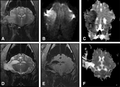 Ischemic Injury Results In Cerebral Atrophy And Aberrant Brain
