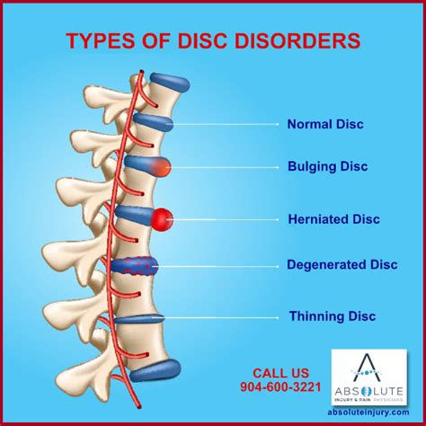 Understanding Intervertebral Disc Disorders Absolute Injury And Pain