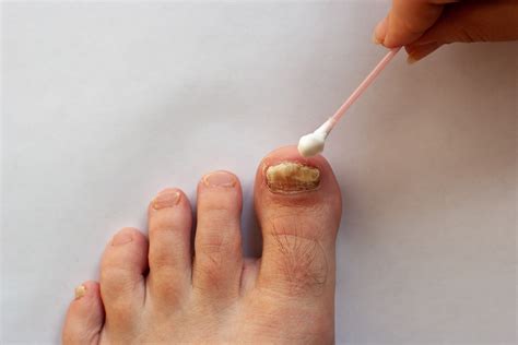What Is The Fastest Way To Get Rid Of Nail Fungus Palmetto State Podiatry