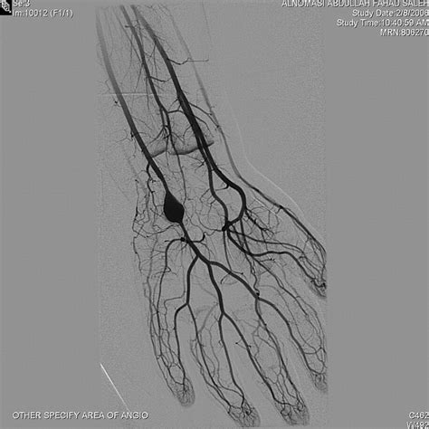 True Ulnar Artery Aneurysm Of The Hand In An 18 Month Old Boy A Case