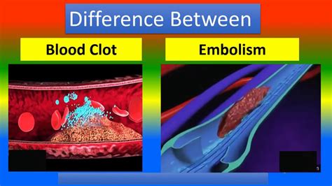 Difference Between Blood Clot And Embolism Youtube
