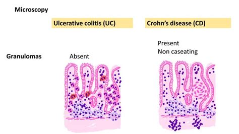 Ulcerative Colitis Vs Crohns Disease Pathology Made Simple