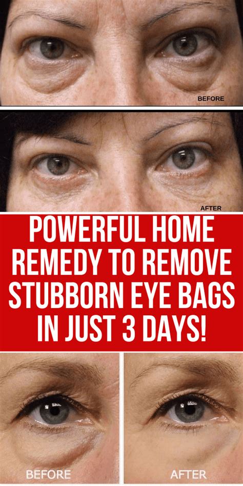 Powerful Home Remedy To Remove Stubborn Eye Bags In Just 3 Days Skin Care Tips Eye Bags