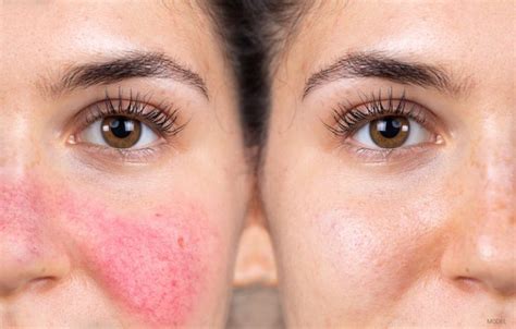 Tired Of Being Caught Red Faced 3 Ways To Treat Facial Redness Nova