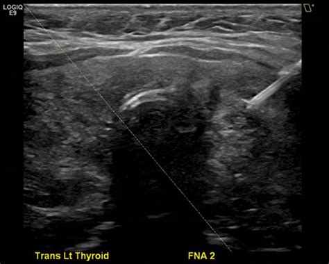 Ultrasound Guided Thyroid Biopsies Allows The Radiologist To Sample The