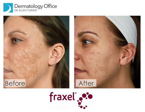 Laser Skin Resurfacing Fraxel Laser Dallas Area Dr Ellen Turner