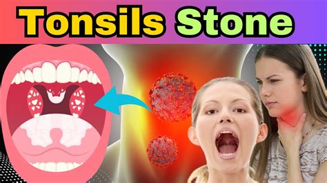 What Are Tonsil Stones How Tonsil Stones Formed Tonsil Stone