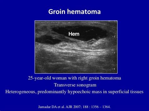 Ultrasound Of The Abdominal Wall Hernias