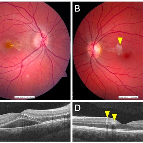 The Figure Shows A Patient With Cat Scratch Disease Bartonella Related