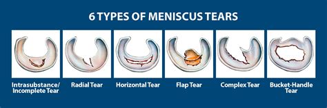 Types Of Knee Meniscus Tears Kulturaupice
