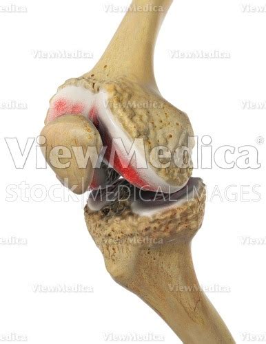 Viewmedica Stock Art Knee In Flexion With Osteoarthritis Anteromedial