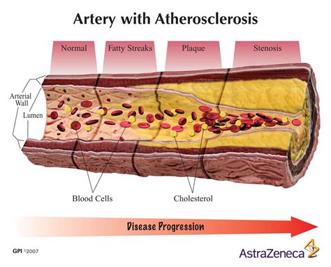 Blocked Artery Symptoms And Silent Heart Attacks Arteries Coronary