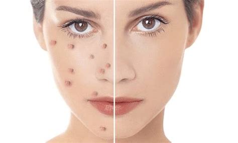 Scars After Papule Pustular And Excoriated Acne Currently The