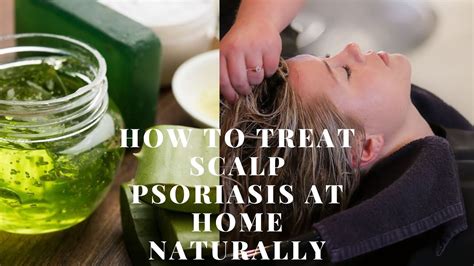 Treating Scalp Psoriasis At Home Naturally Fast Home Remedies Youtube