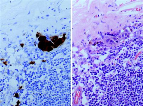 Pathology Of Sentinel Lymph Nodes For Melanoma Journal Of Clinical