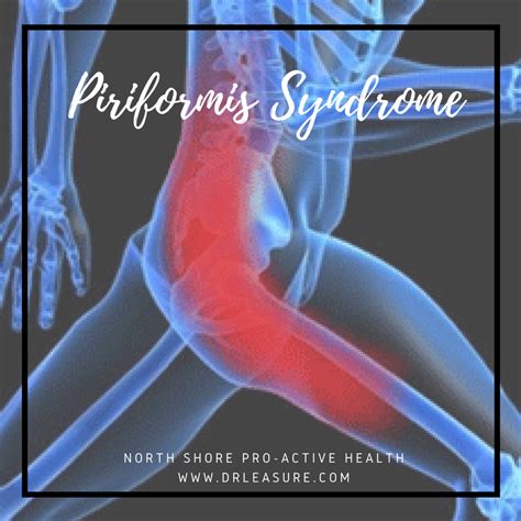 Piriformis Syndrome Causes Symptoms Diagnosis And Tre