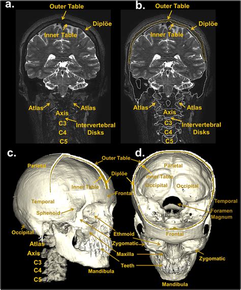 Segmentation Of The Bone Top Coronal View Of A T2 Weighted Mri Slice