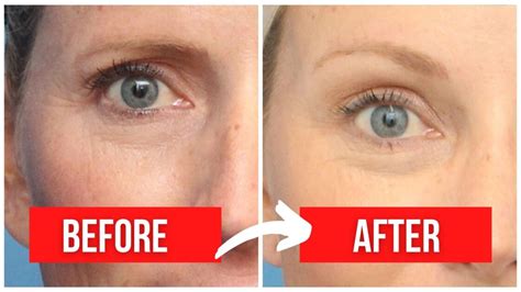 Botox Brow Lift All You Need To Know