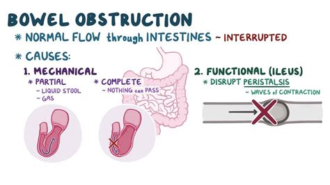 Bowel Obstruction Video Anatomy Definition Osmosis