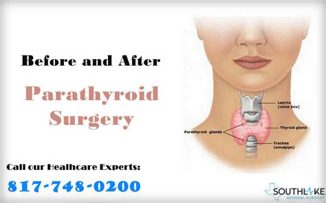Before After Parathyroid Surgery Dr Valeria Simone Southlake