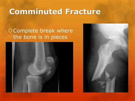 Ppt Fractures Powerpoint Presentation Free Download Id2807558