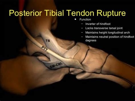 Lecture Trauma Ankletendon