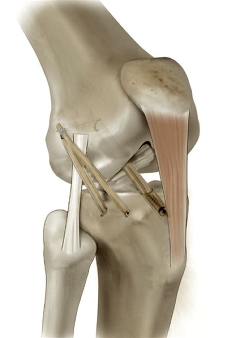 Anterior Cruciate Ligament Reconstruction Combined With Anterolateral
